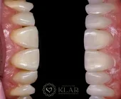 Transforme o seu sorriso de forma rápida e sem desgaste dos dentes! Conheça as facetas de resina!